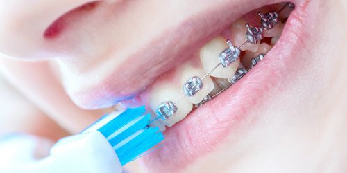 a woman using braces brushing her teeth